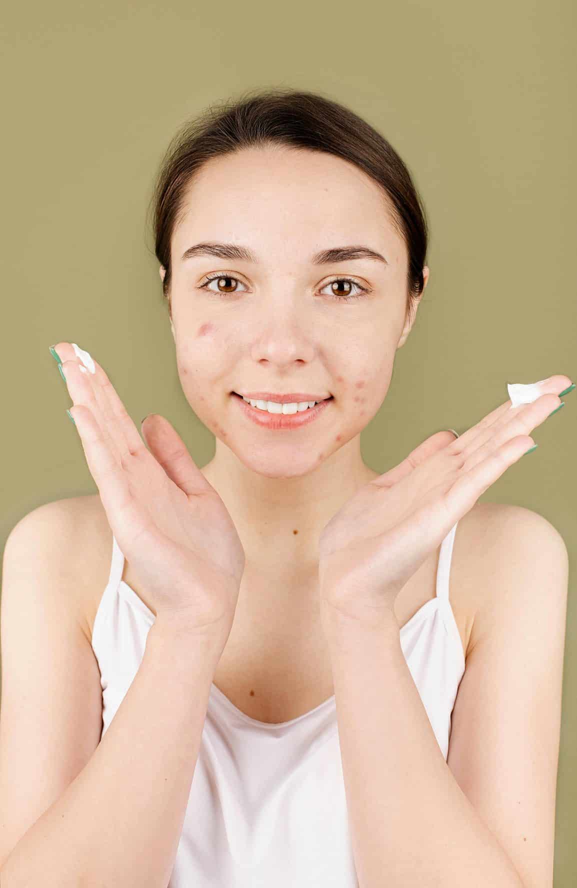 7 Effective Ways to Target Acne Scarring